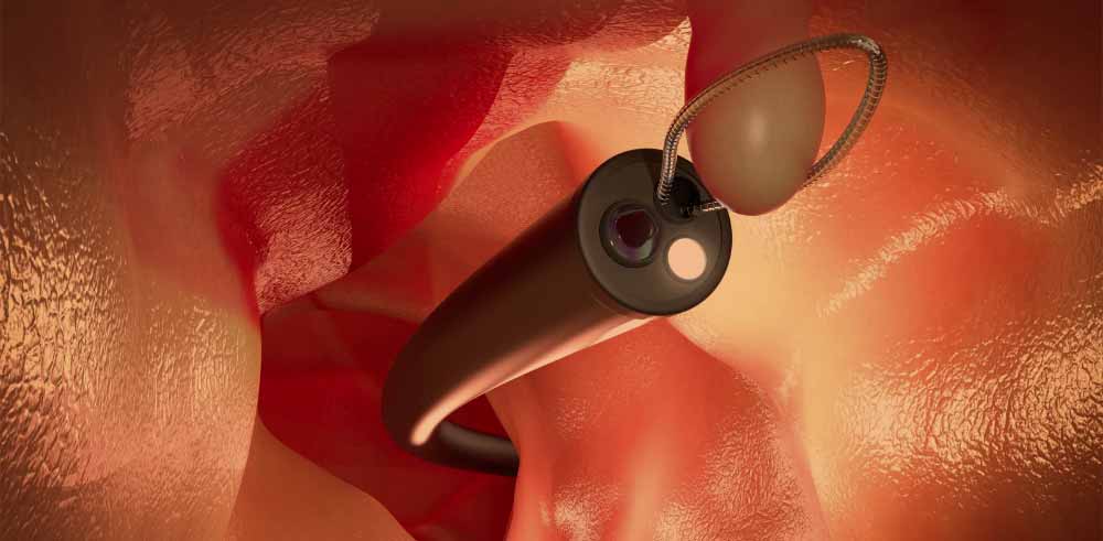 colonoscopy